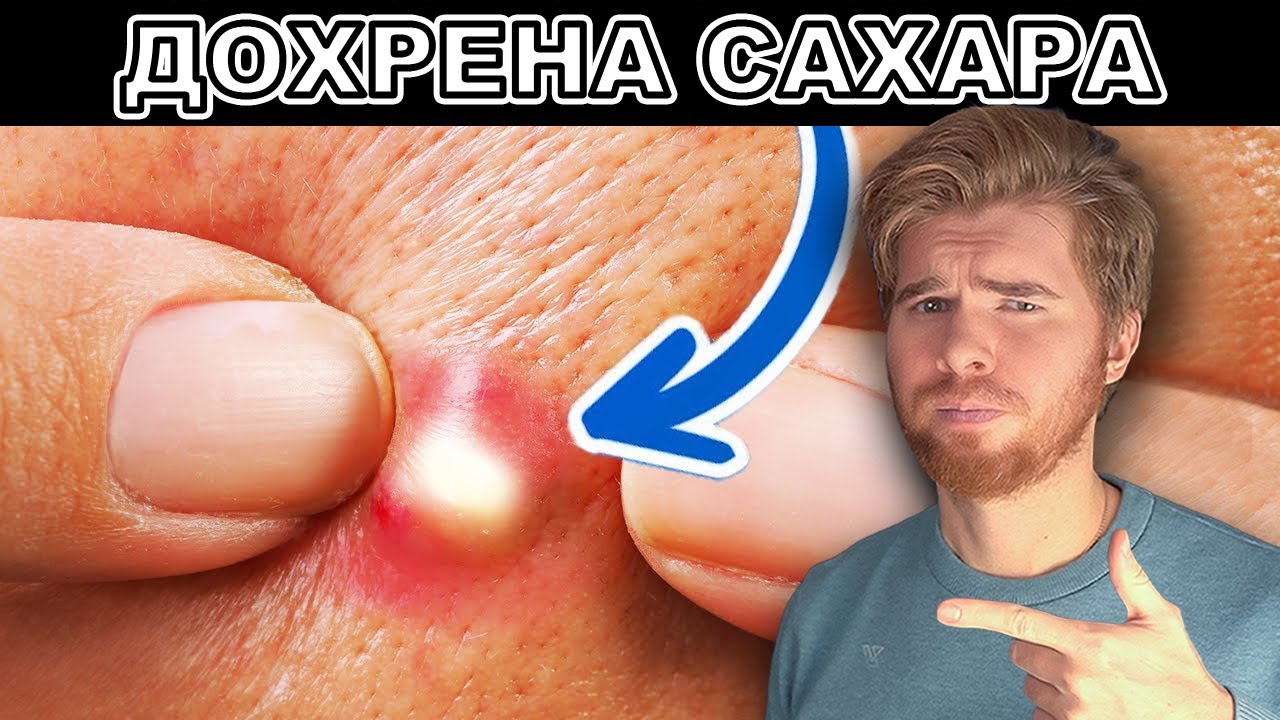 Топ 10 признаков переизбытка САХАРА. Вред сахара №1