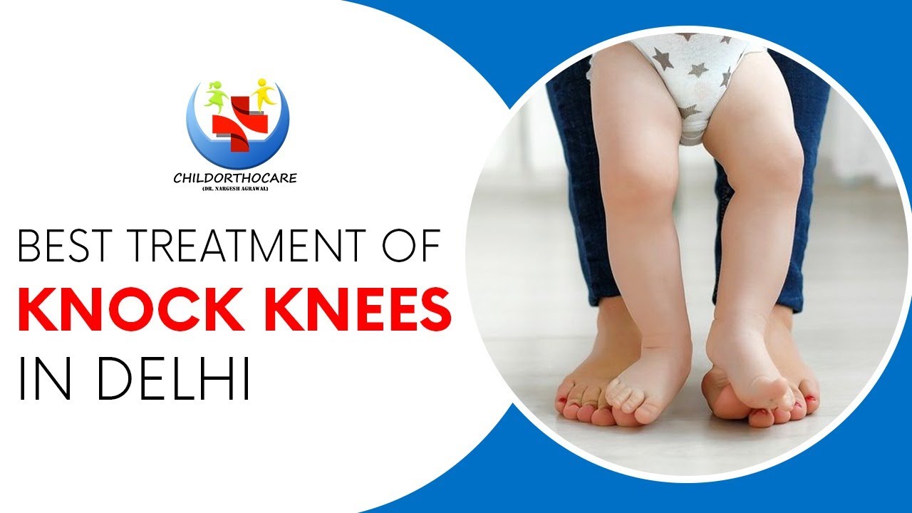 Knock knee treatment surgeon | Dr. Nargesh Agrawal | Child Orthopedic treatment