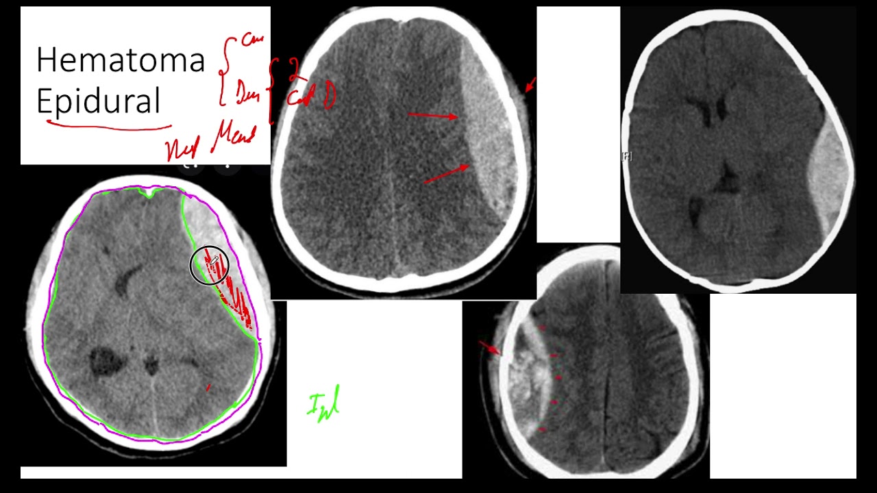 Hematoma Epidural. Tomografía Computarizada . Hemorragia Intracraneal