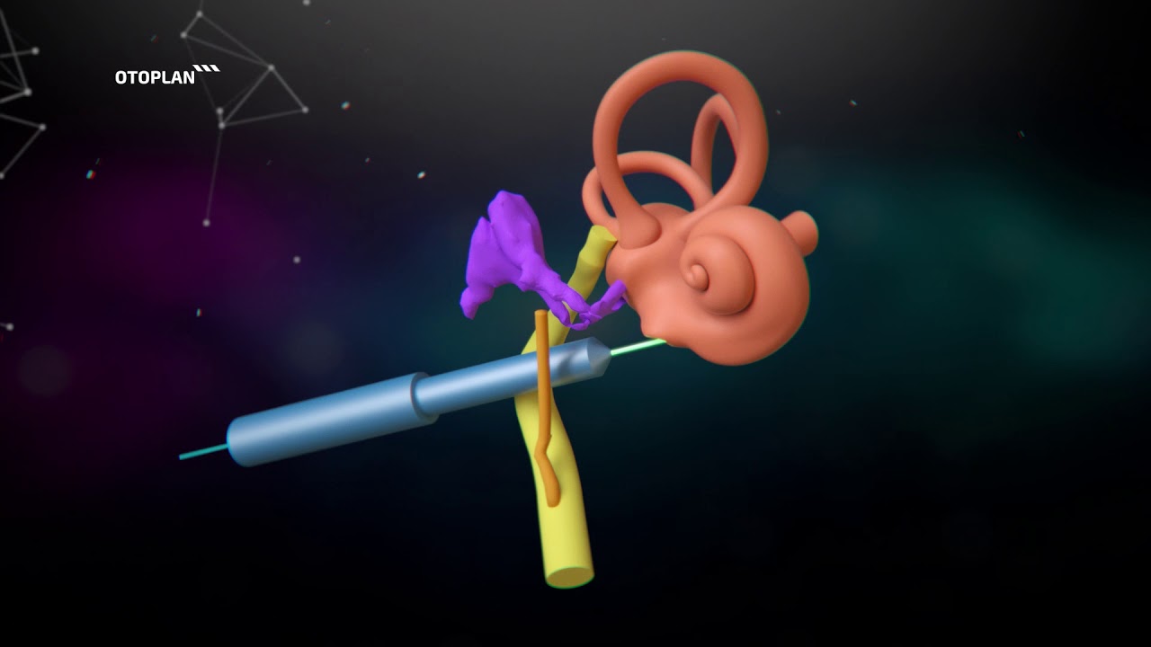 HEARO Robotic Surgery for Cochlear Implants