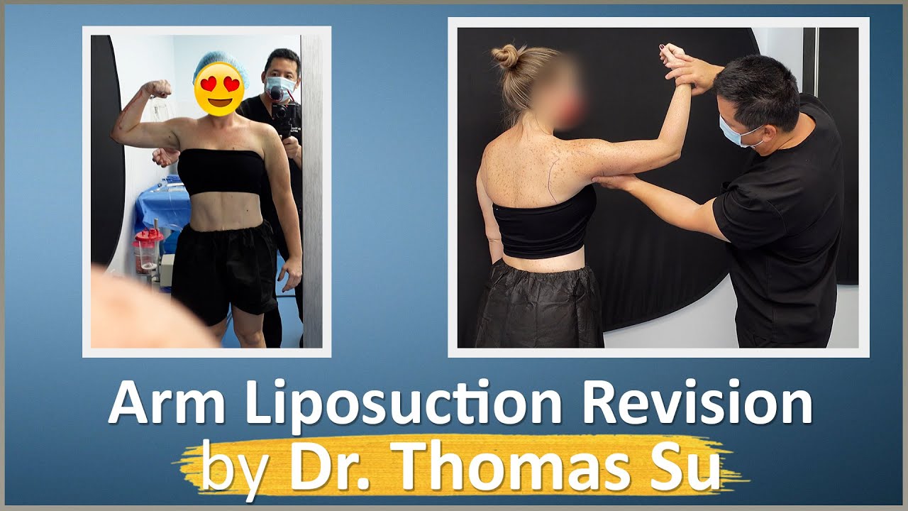 Celebrity Arms™ Liposuction with Renuvion | Lipo 360° Arms | High-Definition Results | Expert Dr. Su