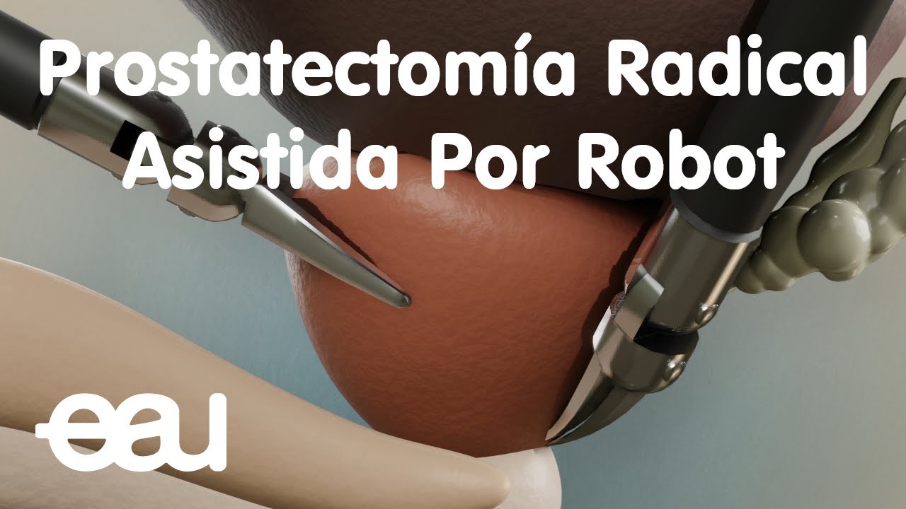 Prostatectomía Radical Asistida Por Robot