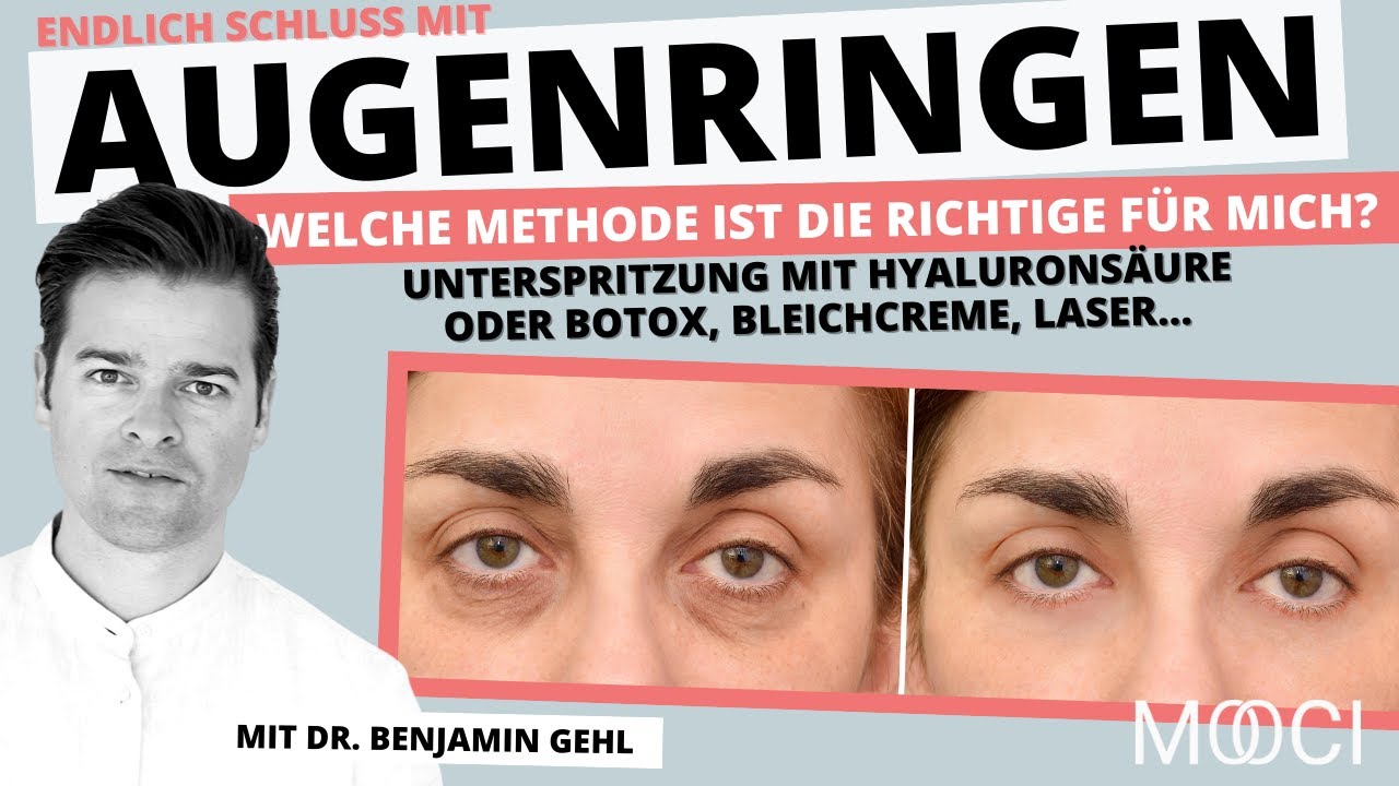 Augenringe sofort & dauerhaft entfernen! Aber wie? 👀