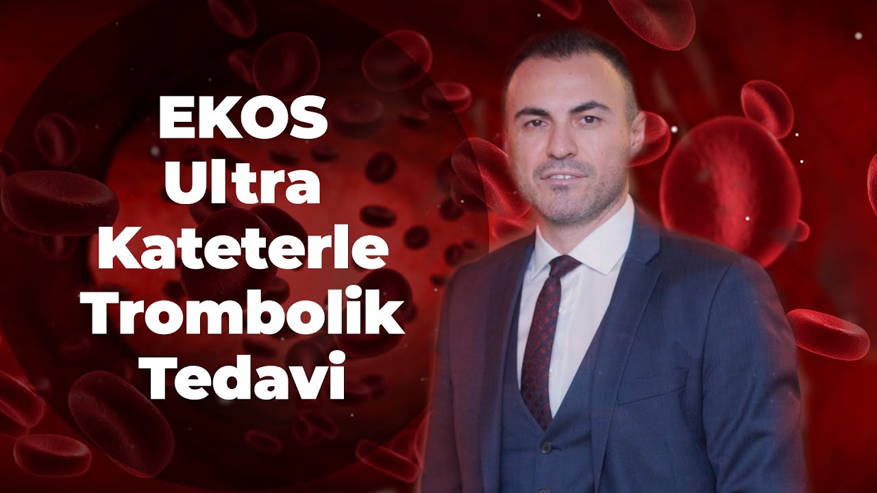 Derin Ven Trombozu'nda EKOS Ultra Kateterle Trombolik Tedavi. | PROF. DR. MERT DUMANTEPE