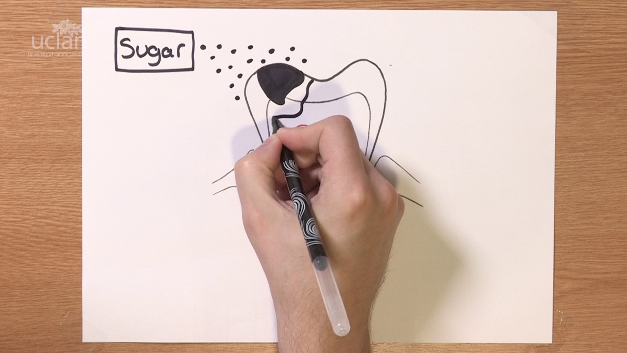 One Minute Lecture - what is a root canal and how is it treated?