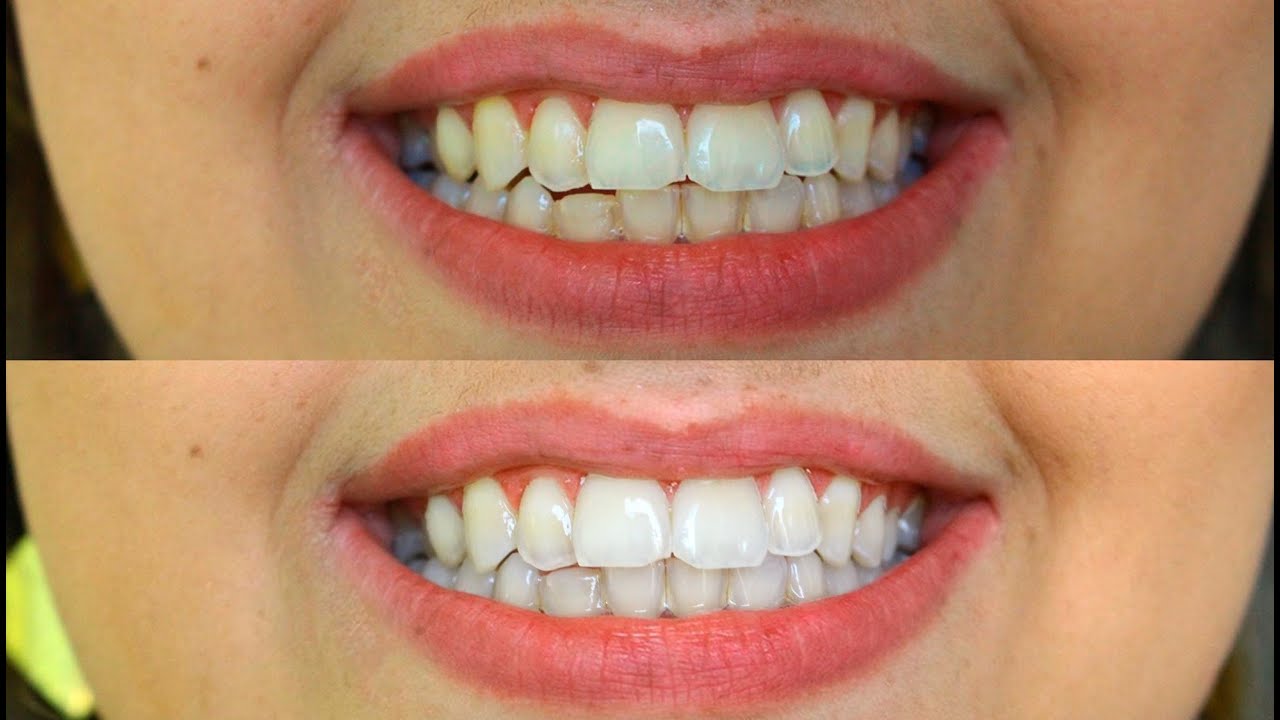Como clarear os dentes em casa
