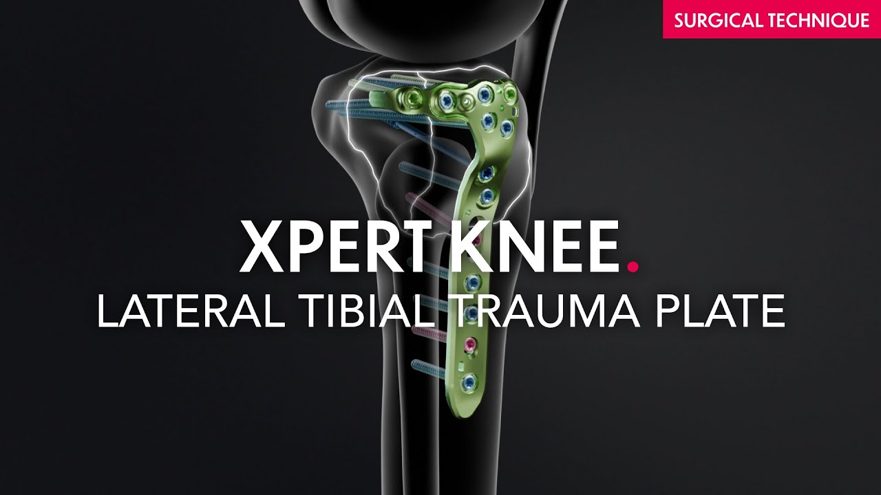 Xpert Knee - Tibial plateau trauma plates - Surgical technique