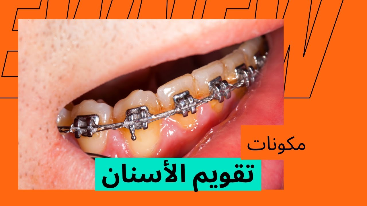 اعرف مكونات تقويم الأسنان وفايدتها