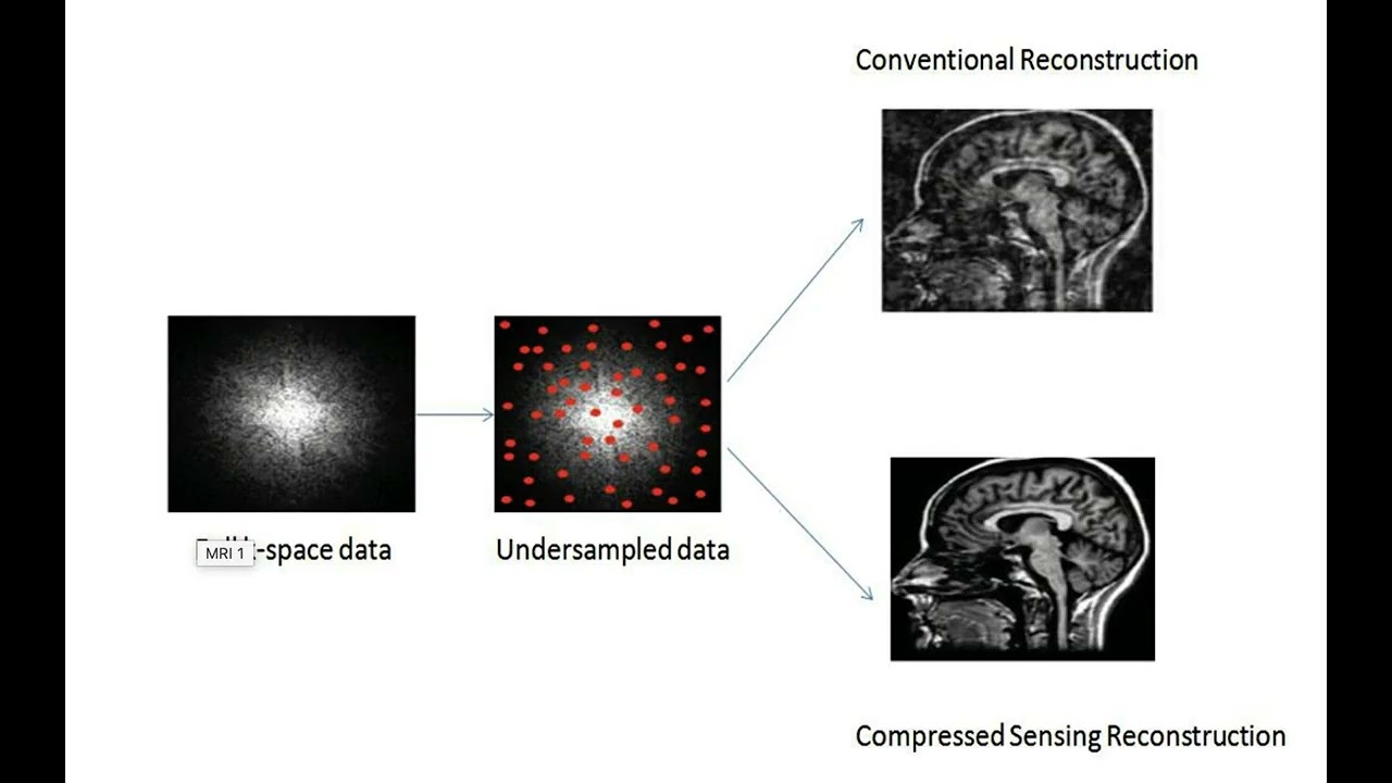 MRI 시간 54배 단축 비밀 압축 센싱과 AI