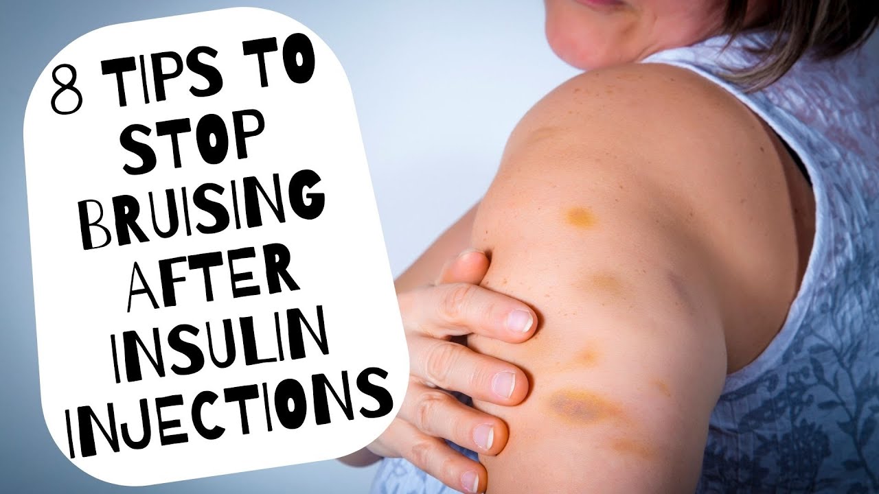 8 Tips to Stop Bruising After Insulin Injections
