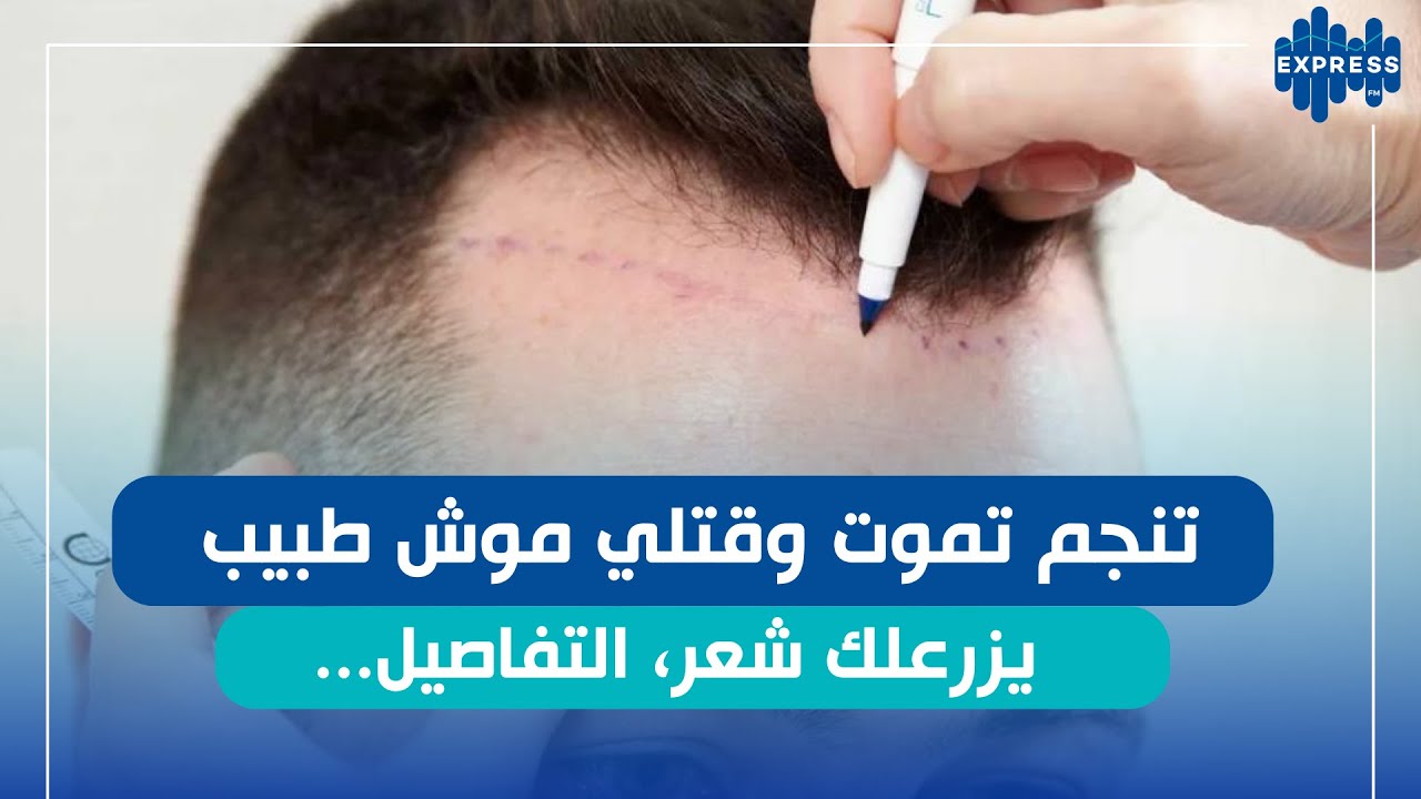 زراعة الشعر في تونس :  هل عملية زرع الشعر تتكلف؟