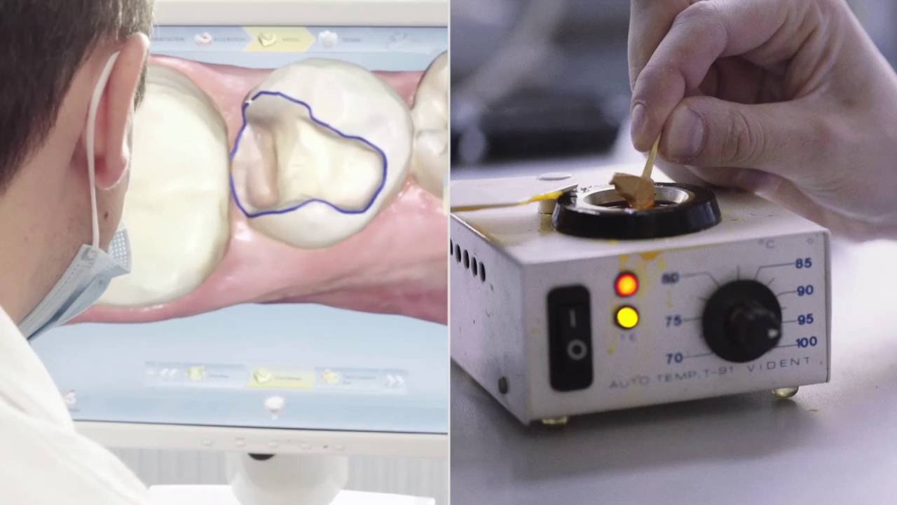 Cerec Omnicam Workflow vs Clasical Dental Lab  Technique
