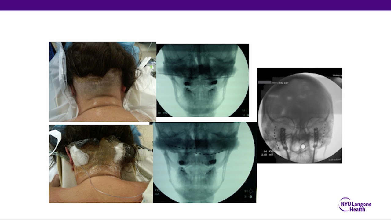 2017 XXIX ASAP Conference:  Peripheral Nerve Stimulation...- A Mogilner