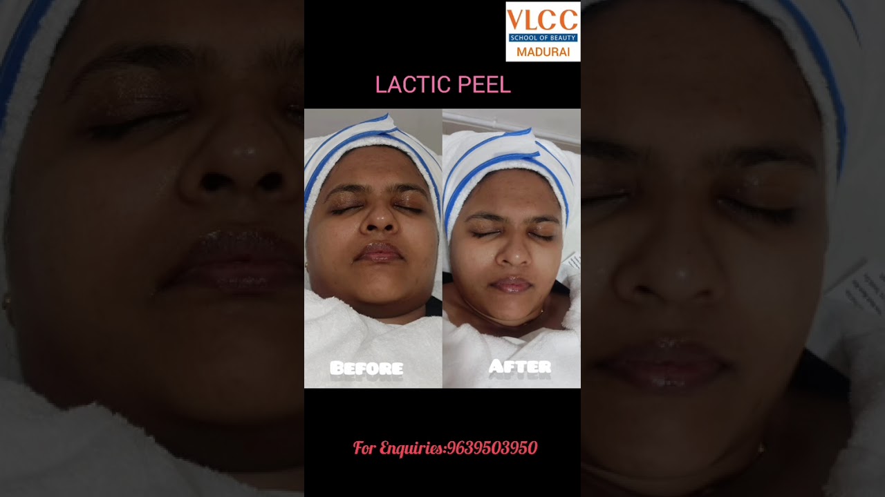 Lactic Peel💫 