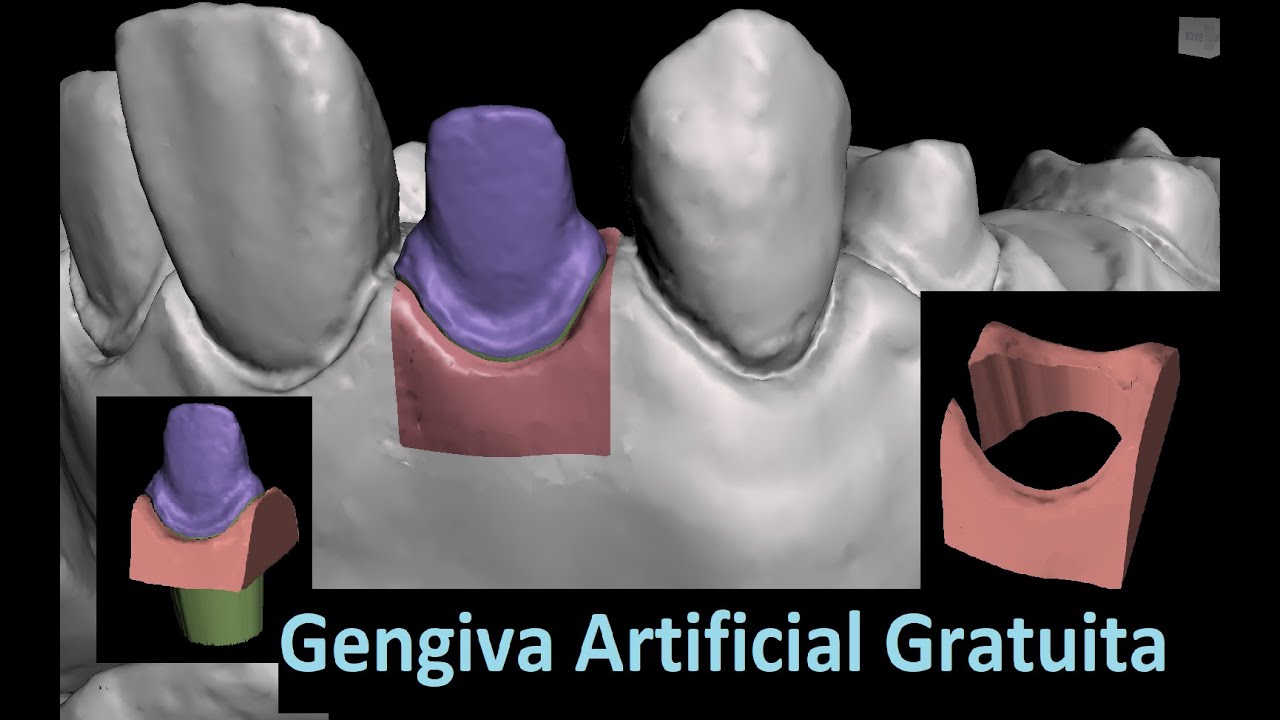 Como Desenhar Gengiva Artificial e Troquel em Programa Gratuito