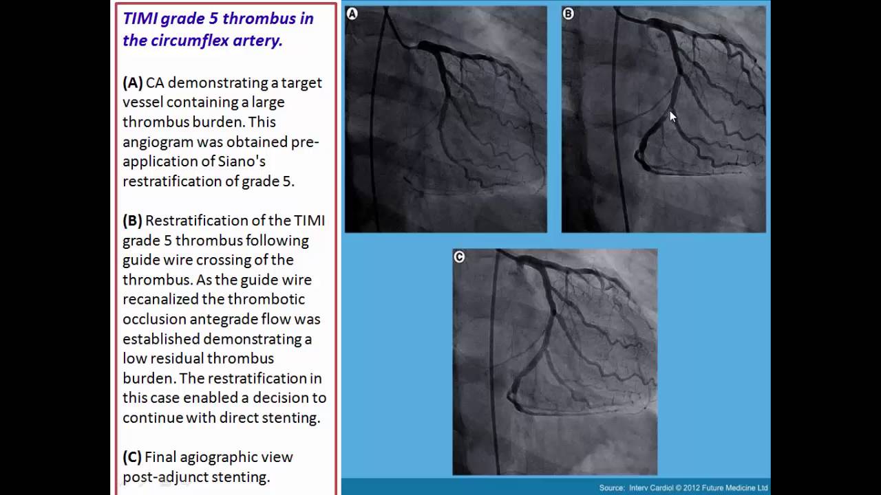 Thrombus containing lesions
