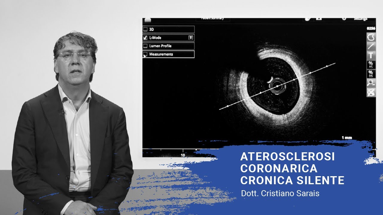 Aterosclerosi coronarica cronica silente - Dott. Cristiano Sarais
