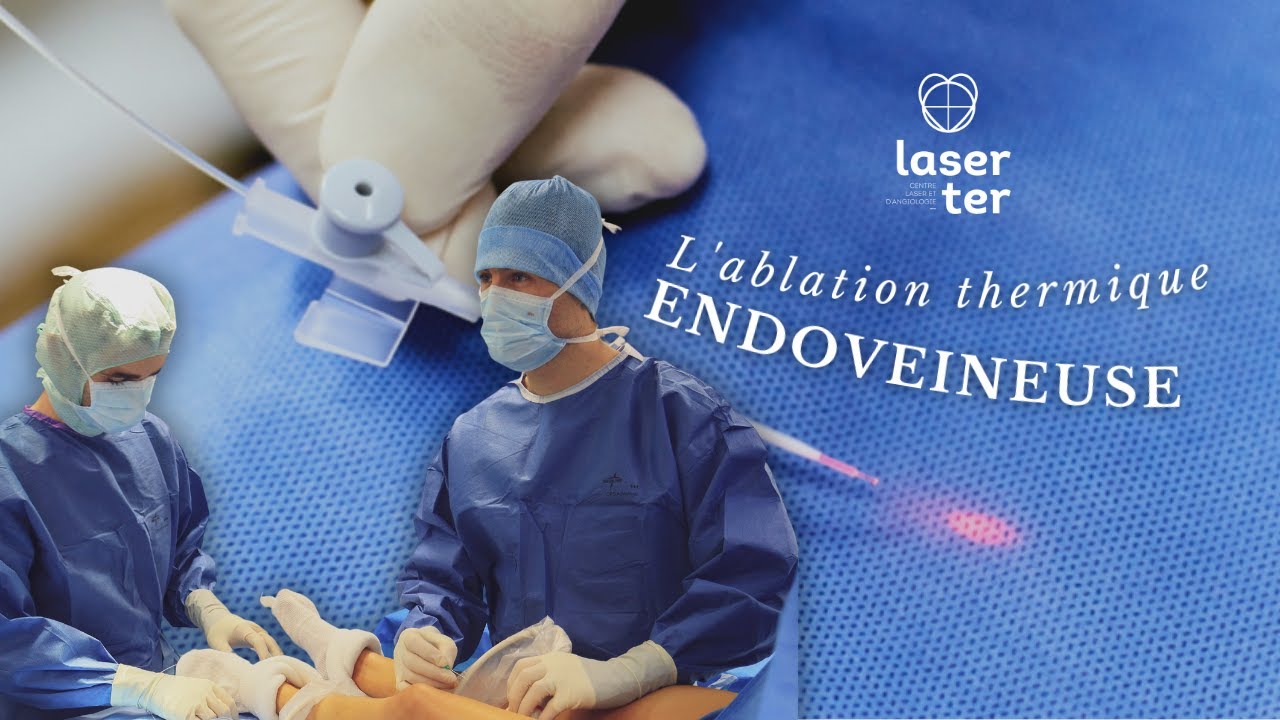 L'ablation thermique endoveineuse