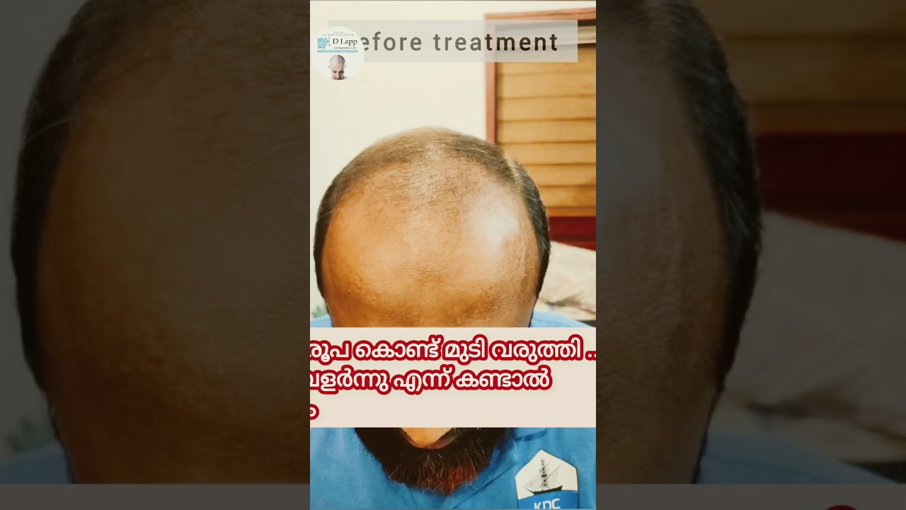No more hair transplantation if you have this. #dlapp #hairloss #baldnesstreatment #hairtransplant