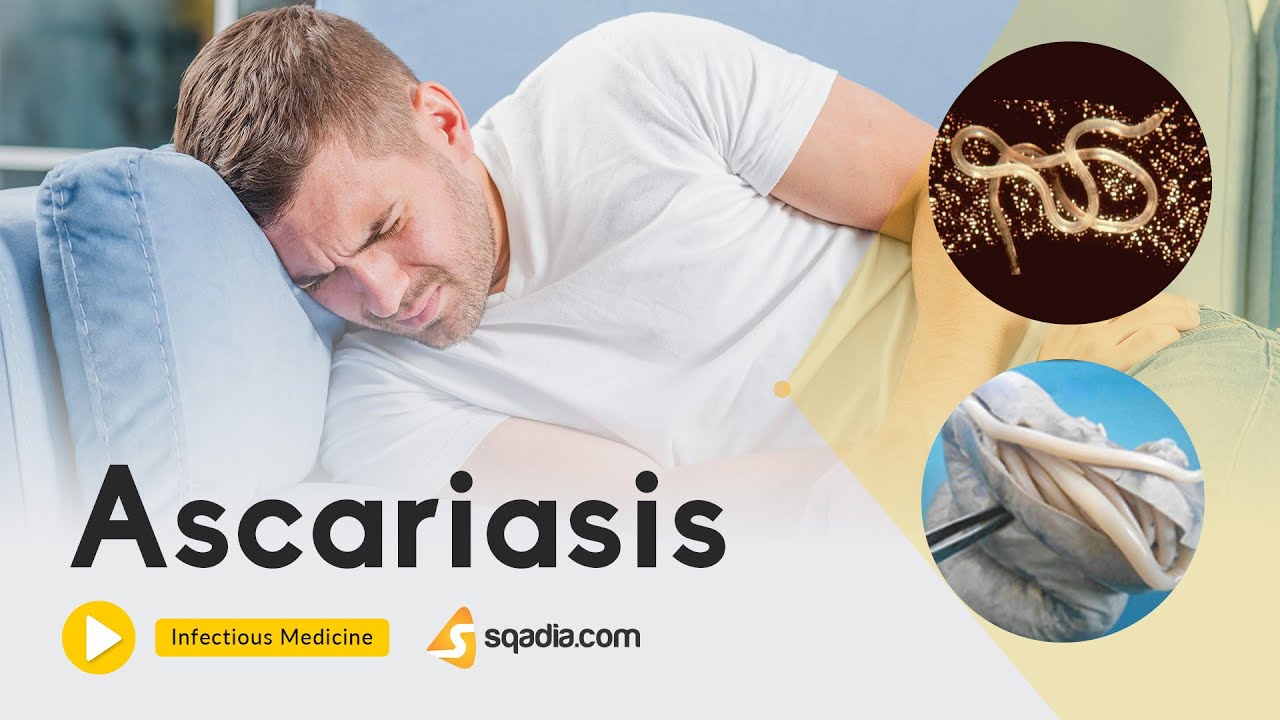 Ascariasis | Infectious Medicine Video | Medical Online Education | V-Learning&trade;