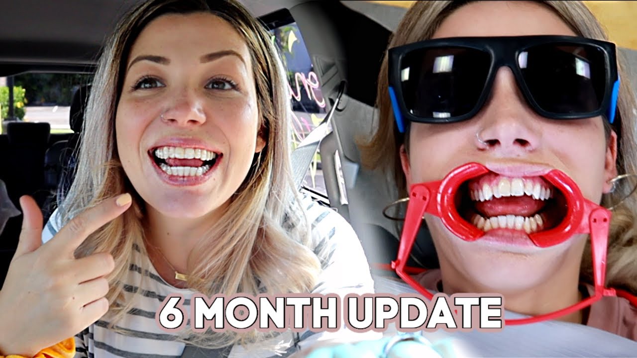SHOCKING 6 MONTH INVISALIGN UPDATE!
