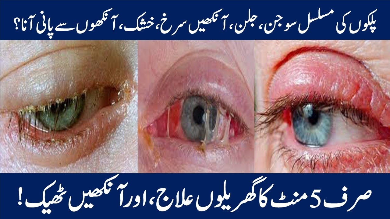 Blepharitis,Causes,Signs & Symptoms|Treatment|Eye infections Home remedies|In Urdu\Hindi