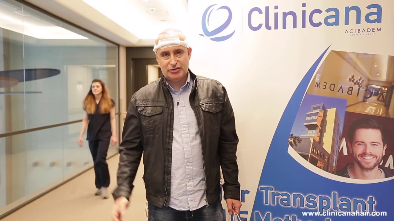 Miguel &Aacute;ngel Puente presentador de TV - Trasplante de Pelo - Microinjerto Capilar Clinicana