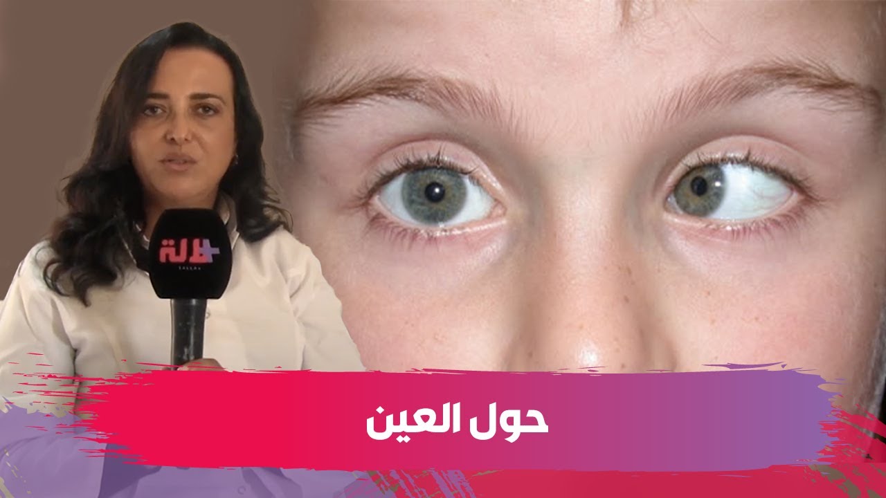 الحول.. طبيبة عيون تكشف أسبابه وأعراضه وطرق علاجه