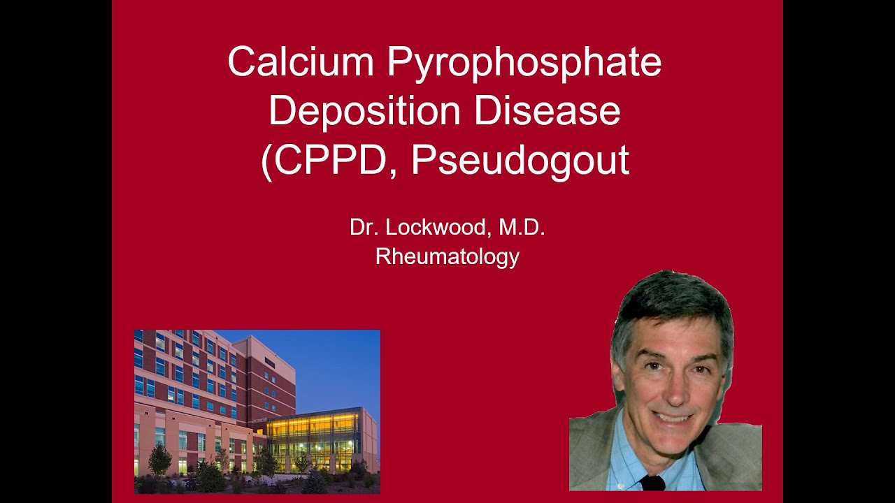 10 Calcium Pyrophosphate Deposition Disease (Pseudogout)