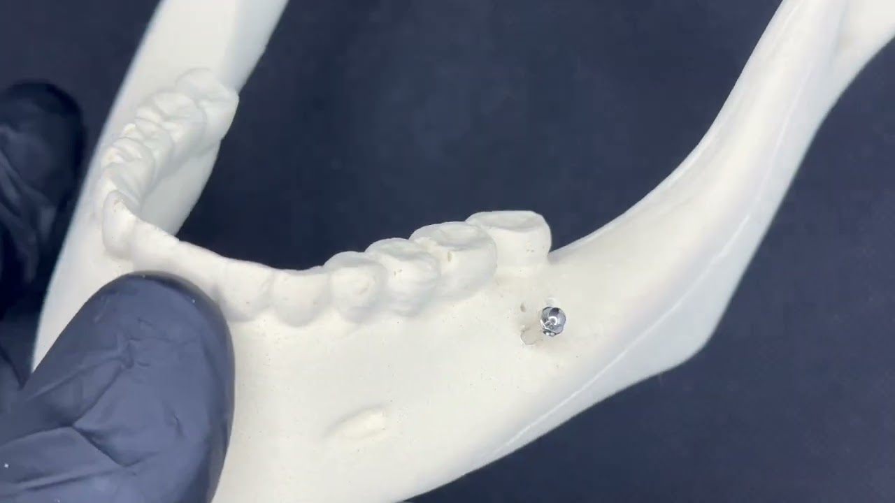 Motor inal&aacute;mbrico para mini implantes ortodoncia