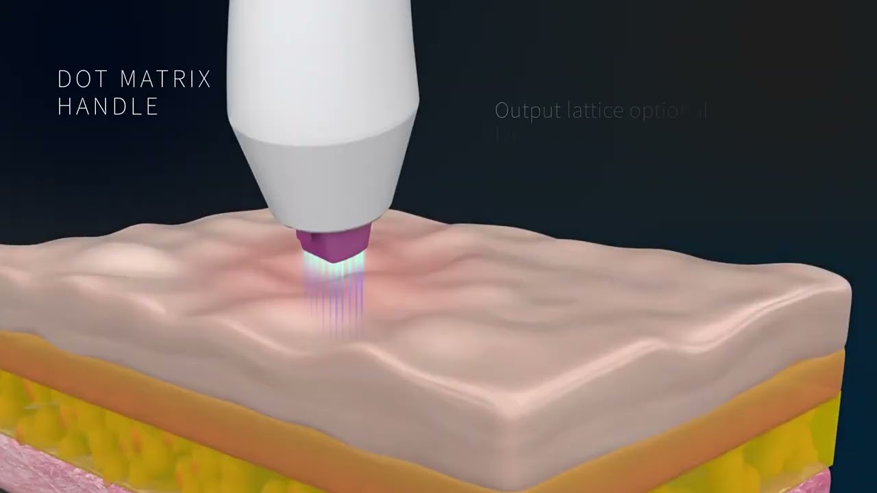 3 in 1 Fractional Hot Cold Plasma Pen Beauty Machine: Eyelid Lifting, Wrinkle & Freckle Removal