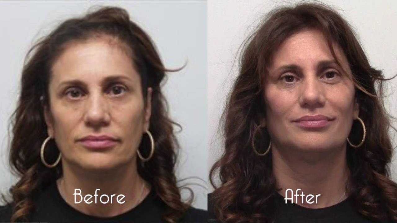 Symmetric Beauty with Calipers and Dr Marina Peredo's Aesthetic Ability