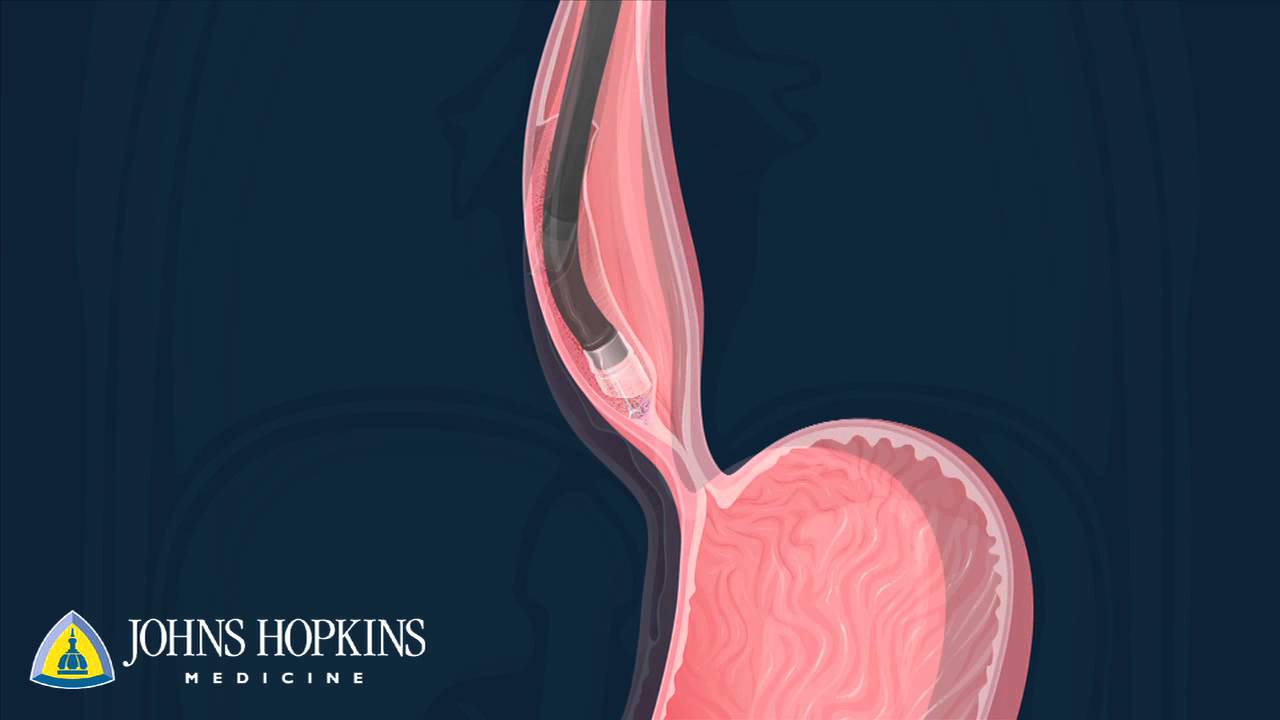Peroral Endoscopic Myotomy (POEM) | Q&A