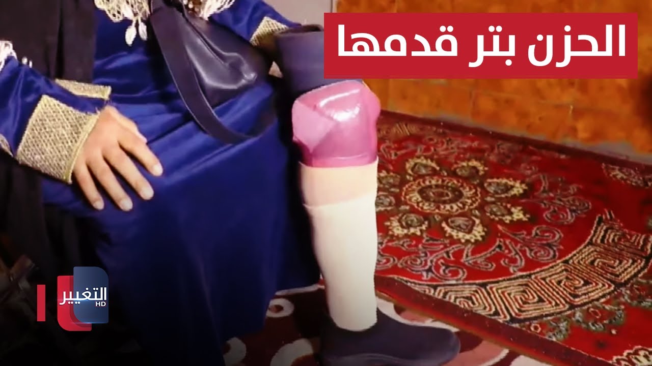 الحزن بتر قدمها.. عراقية تستنجد برئيس الوزراء لإنصافها | نريد وطن
