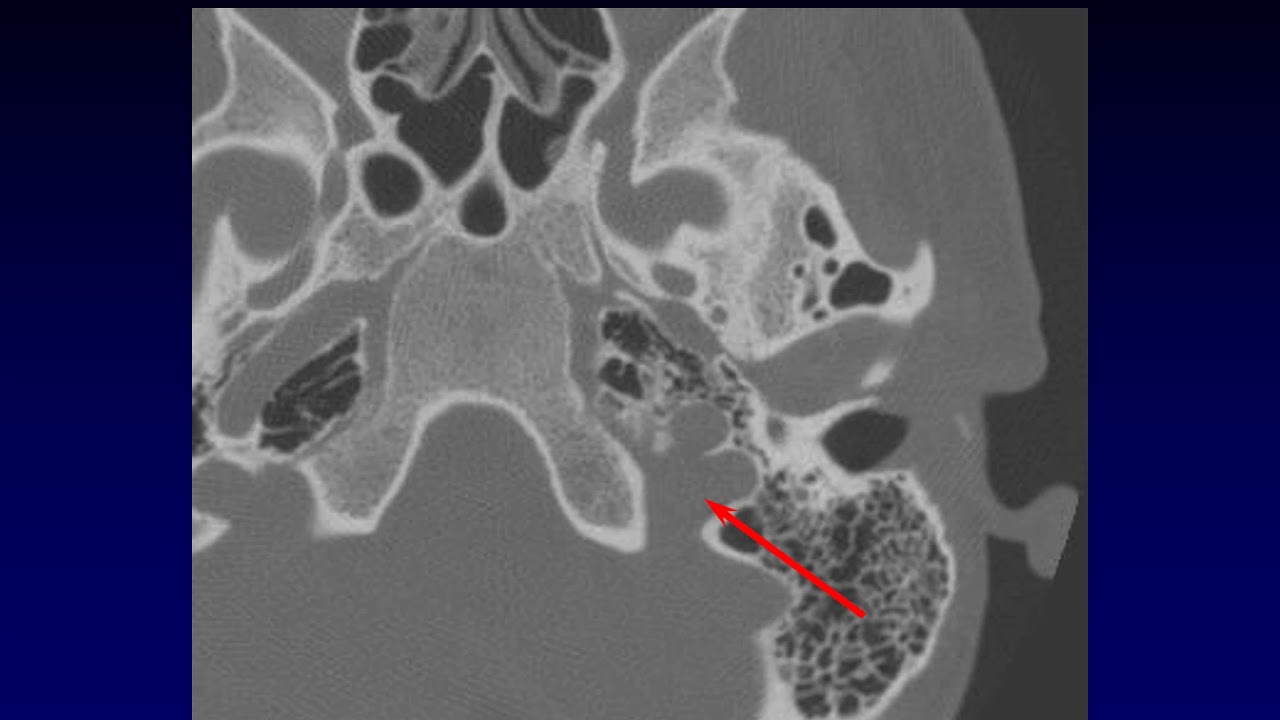 Temporal Bone Anatomy 2