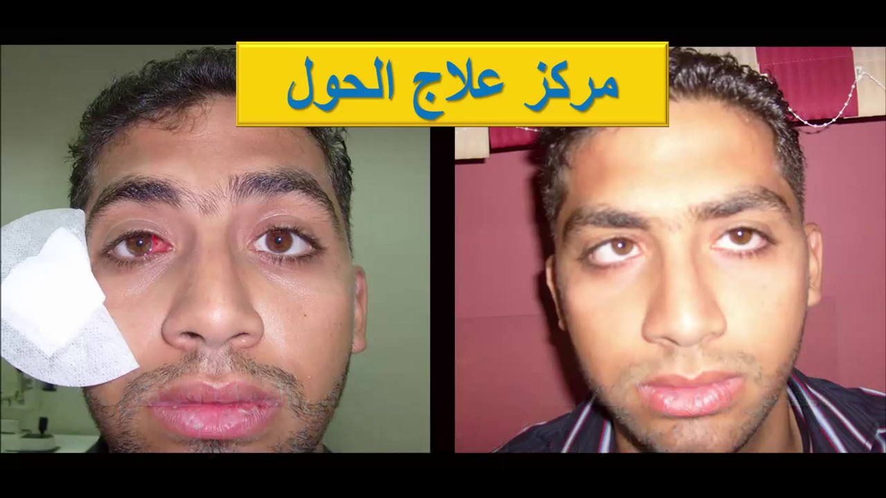 احمرار العين بعد عملية الحول