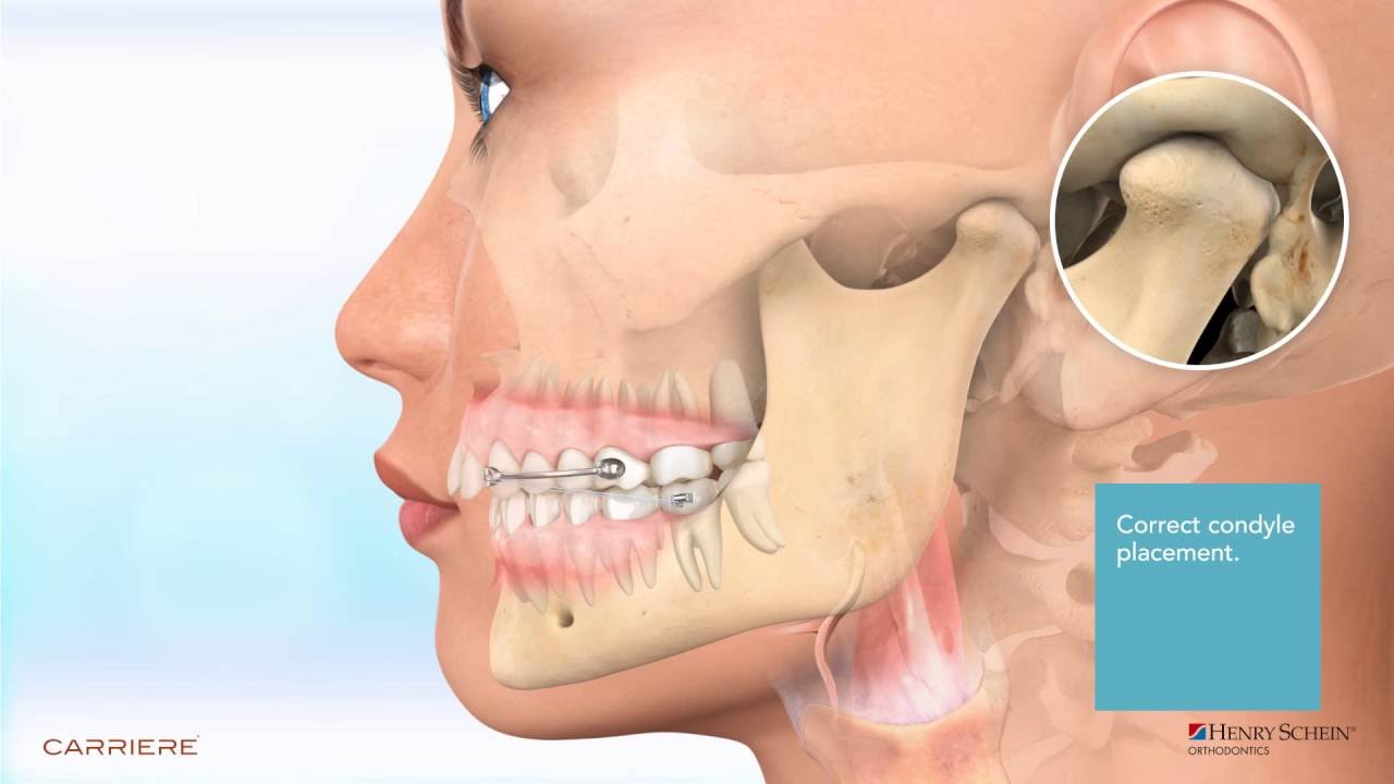 Carriere&reg; Motion&trade; Appliance for Class II Patient Education Animation 2