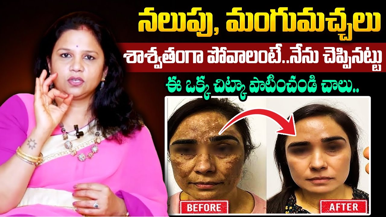 నలుపు, మంగుమచ్చలు శాశ్వతంగా పోవాలంటే.. | Vanaja Ramisetty About Pigmentation | Dark Spots | SumanTv
