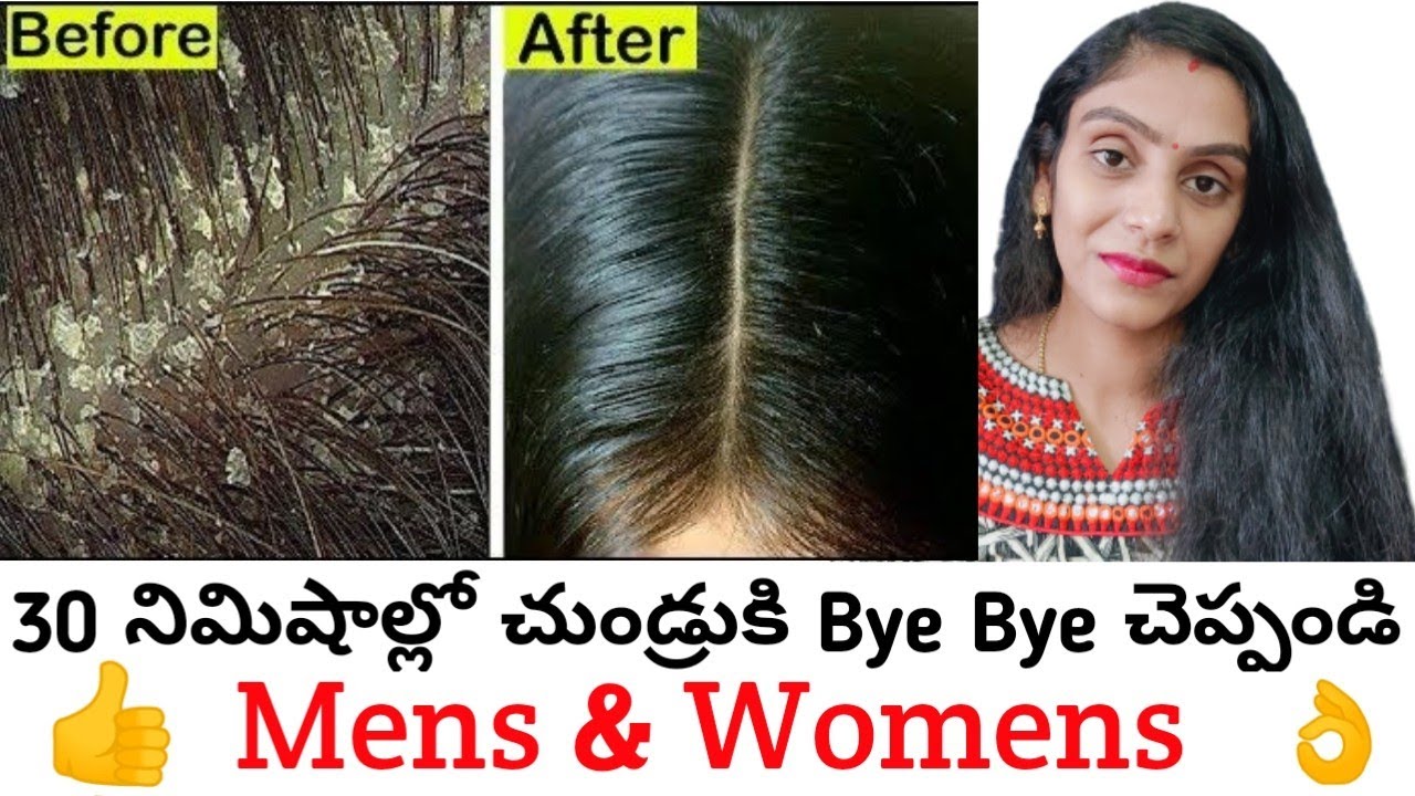 Dandruff కి Permanent Solution At Home (For Men & Women) In Telugu Remove Dandruff Fast With 3 steps
