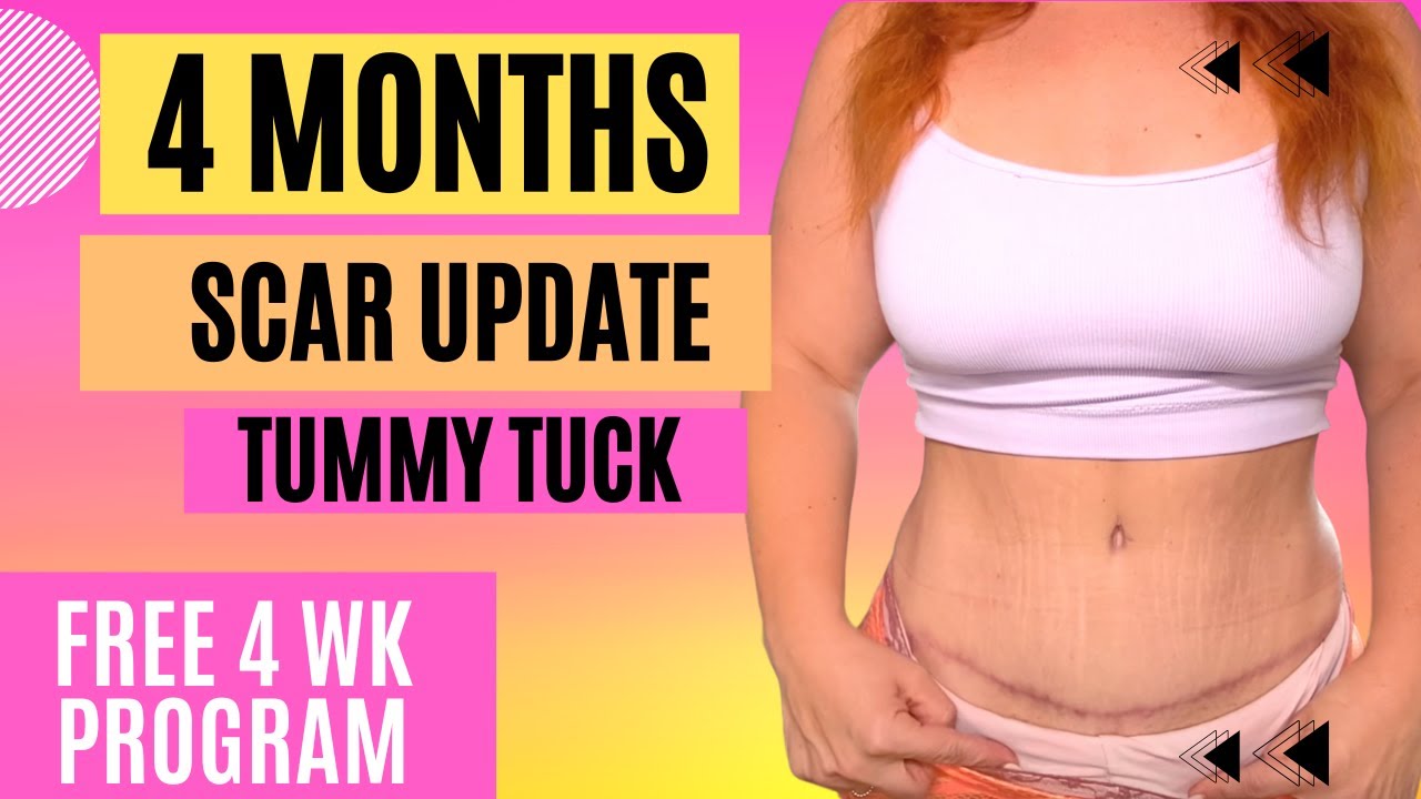 4 Month Tummy Tuck + Scar Update | Free program!