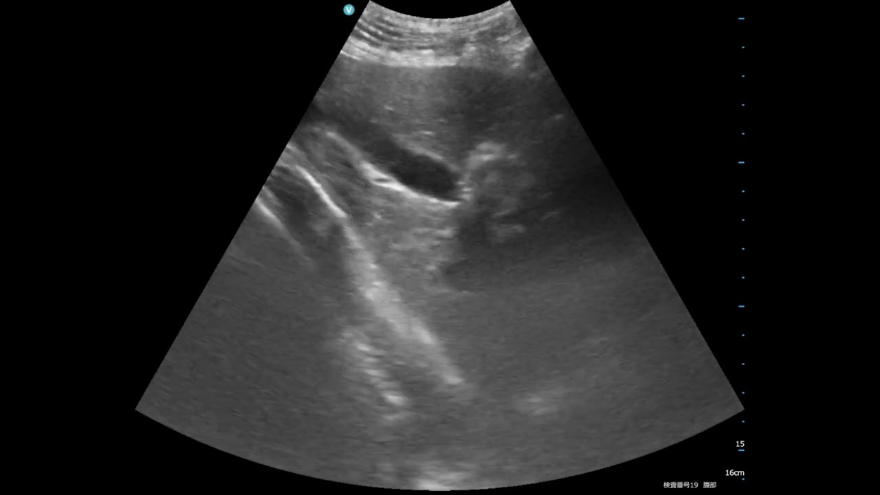 Biliary sludge, Pocket size vs Stationary high-end system、eho images、Dog(28 kg)（ 犬の胆泥症のポケットエコー）