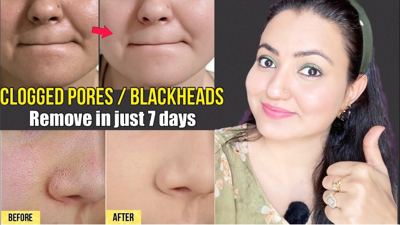 सिर्फ 7 दिनों  में खत्म करे Clogged Pores, Blackheads, Whiteheads और Large Pores एक साथ💕