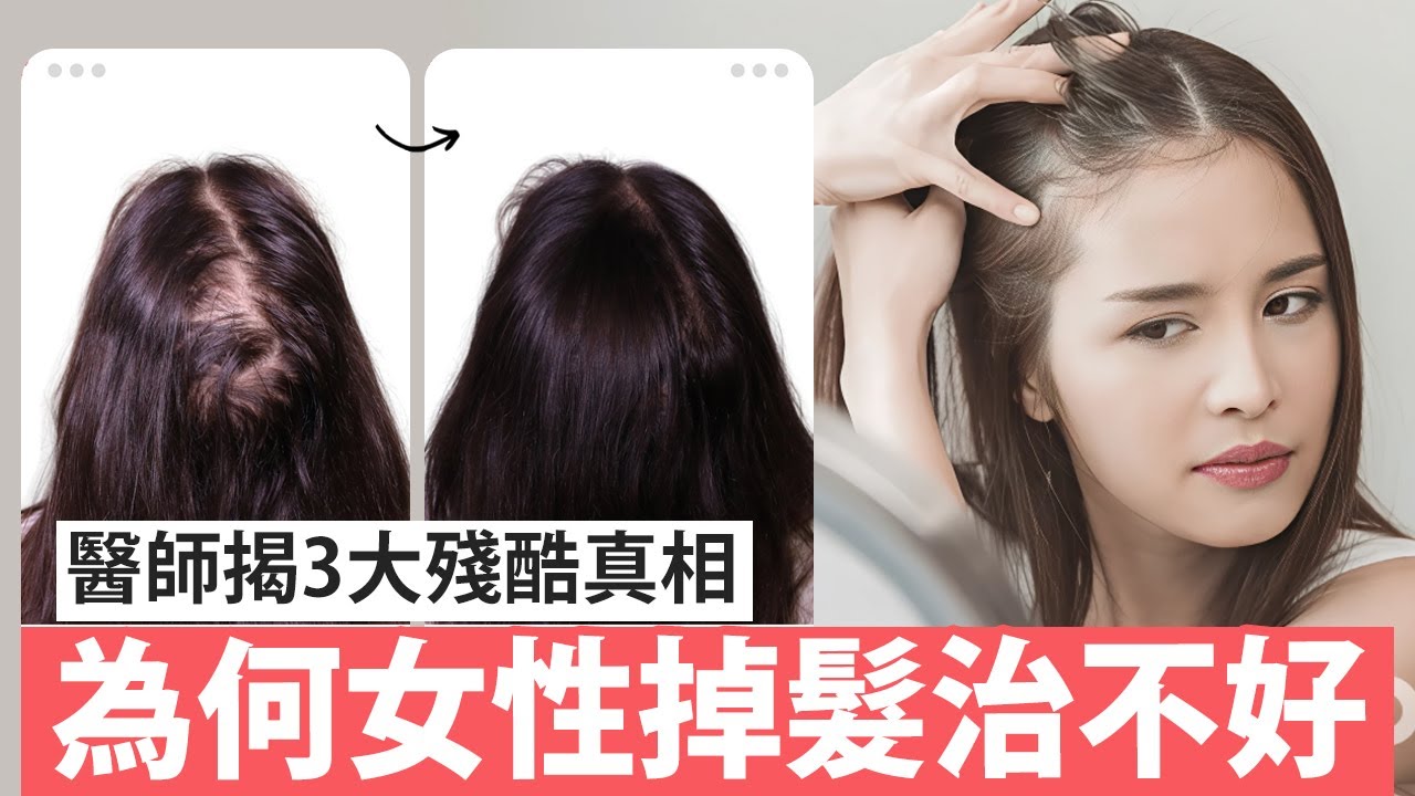 女性掉髮比男性難治？醫師一次講清楚！