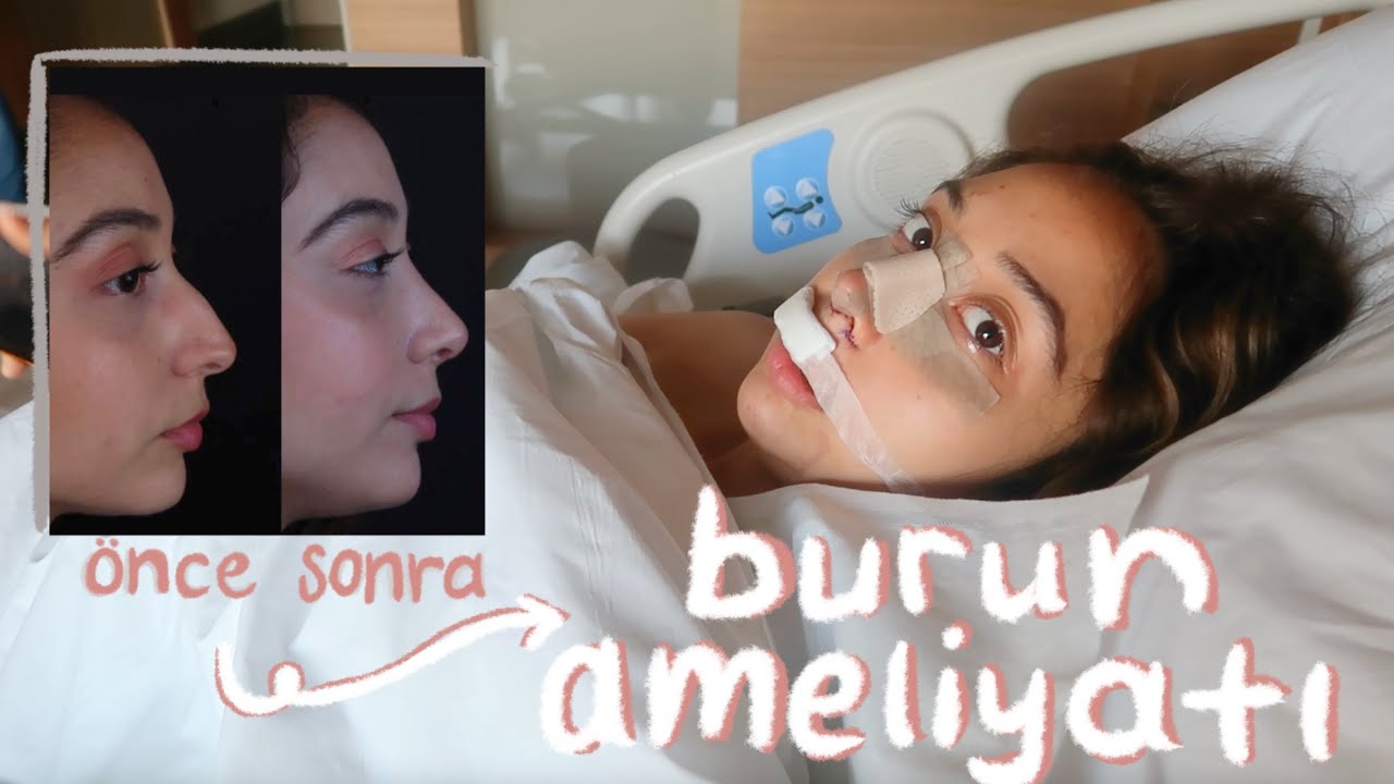 BURUN AMELİYATI HAKKINDA HER ŞEY! 👃🏻
