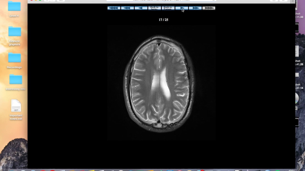Haemosiderin staining brain MRI
