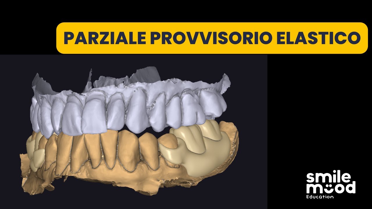 Tutorial Exocad | Parziale provvisorio elastico