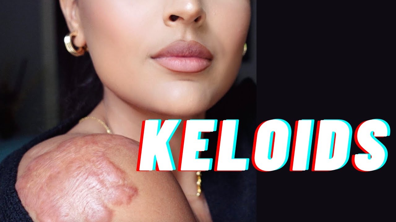 My Keloid Journey | Ep. 1 - How I Developed Keloids & Cushing's Syndrome