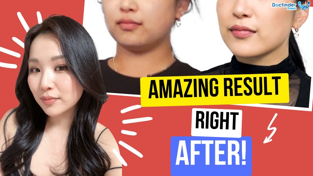Our manager gets rid of SAGGING CHEEKS | Laser Face Lift in Korea. Anti-Aging Non-Surgical Treatment