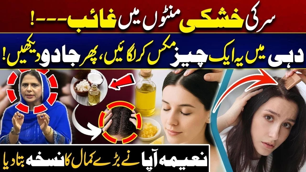 Home Remedies for Dandruff   Natural Dandruff Removal Hack   City 41