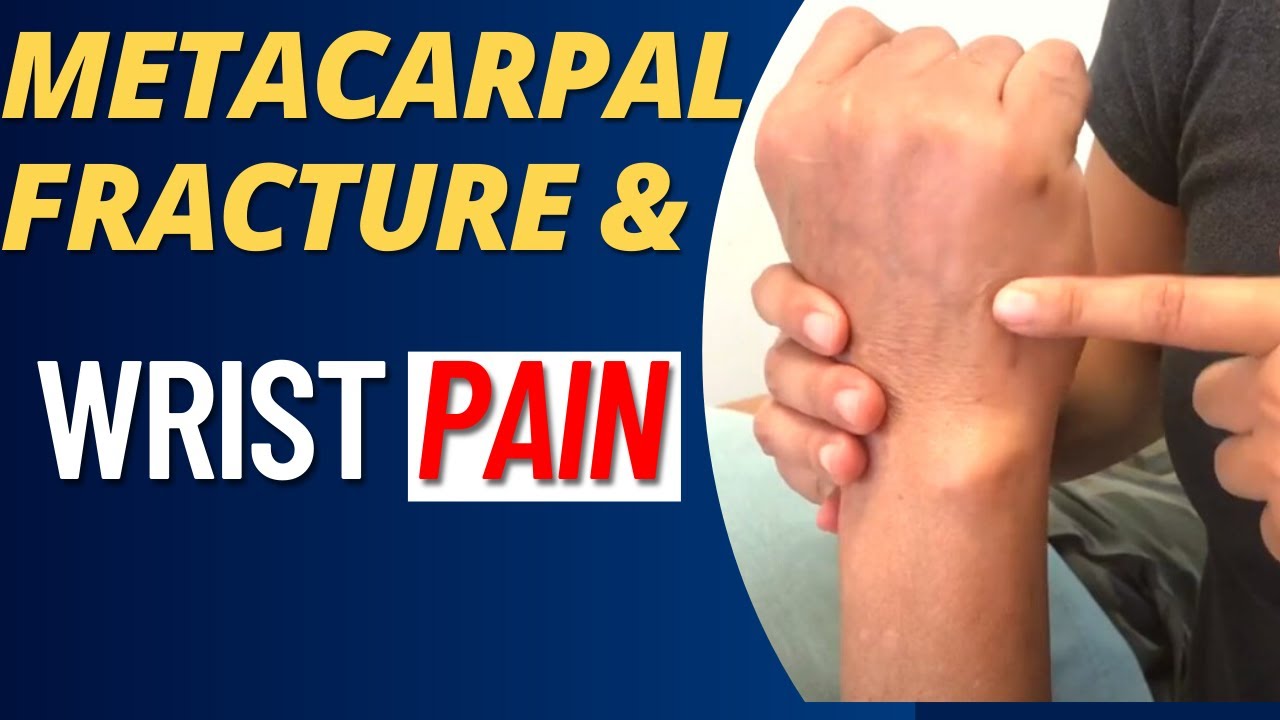 Metacarpal Fracture Rehab (Boxer's Fracture) How does it Affects Wrist Pain